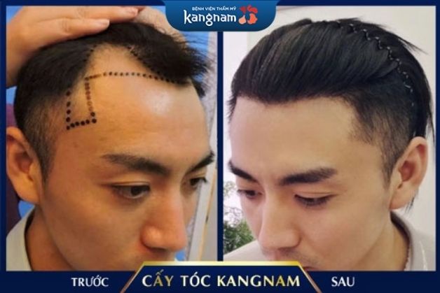 Xóa hói trán cấp tốc tại Kangnam