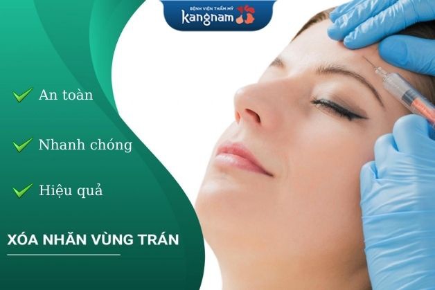 Xóa nhăn trán bằng botox tại Kangnam tiêm botox xoá nhăn trán