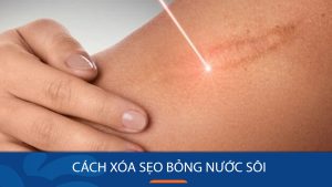 8 Cách Xóa Sẹo Bỏng Nước Sôi Hiệu Quả Tại Nhà