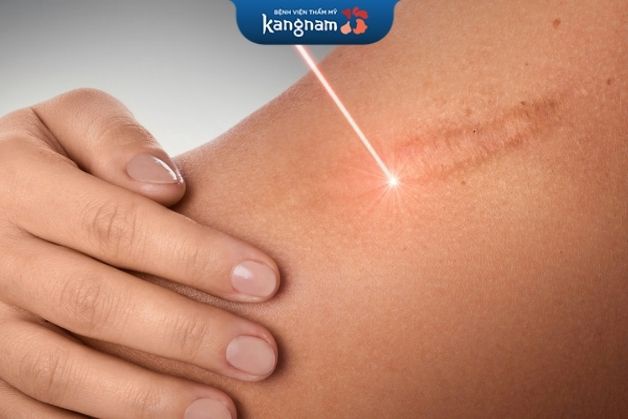 Xóa sẹo nhanh với laser bóc tách