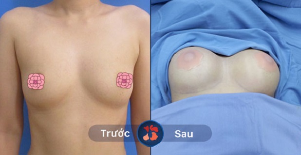 Vòng 1 thay đổi sau khi nâng ngực