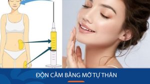 Độn cằm bằng mỡ tự thân: Bí quyết sở hữu khuôn mặt V-line hoàn hảo