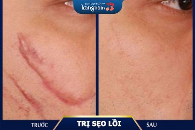 Chữa sẹo xấu trên mặt bằng công nghệ hiện đại