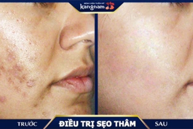 Chữa sẹo thâm mụn hiệu quả