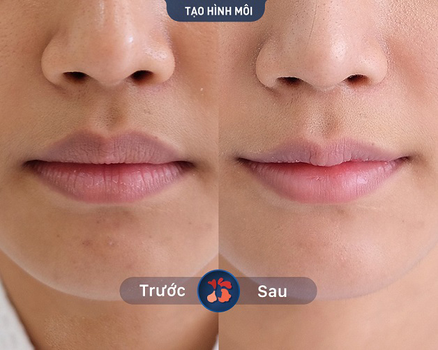 Khách hàng thực hiện thành công phun môi tại Kangnam