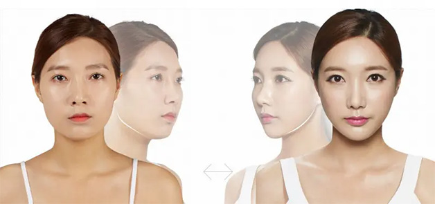 Phẫu thuật nâng cằm bằng CN cao