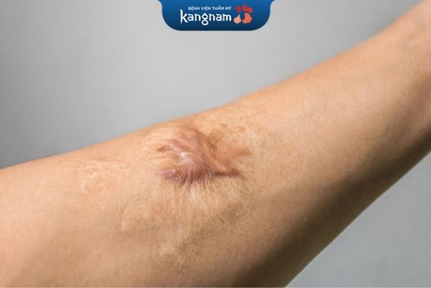 Sẹo co rút do bỏng