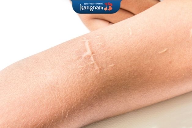 Sẹo xuất hiện do nhiều nguyên nhân