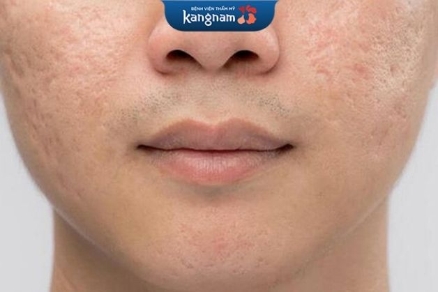 Sẹo mụn trên mặt