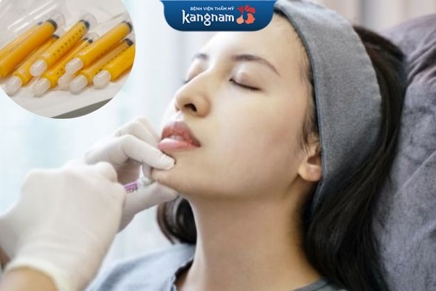 Độn cằm bằng mỡ tự thân