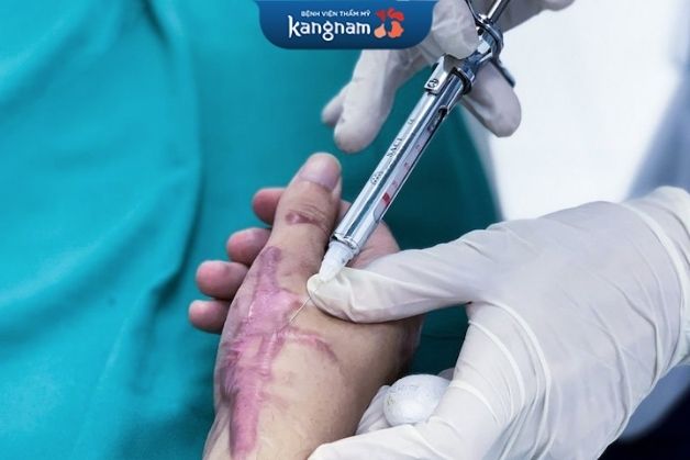 Trị sẹo bằng cách tiêm steroid