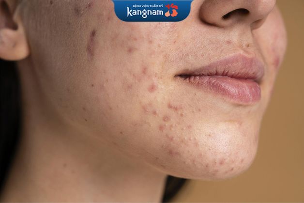 Vết sẹo, thâm hình thành do các đốm mụn để lại