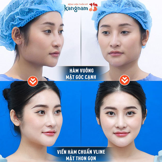 Dáng cằm chữ V thon gọn, tự nhiên.