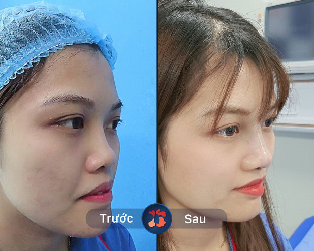 Thu gọn cánh mũi tại kangnam an toàn, bền đẹp