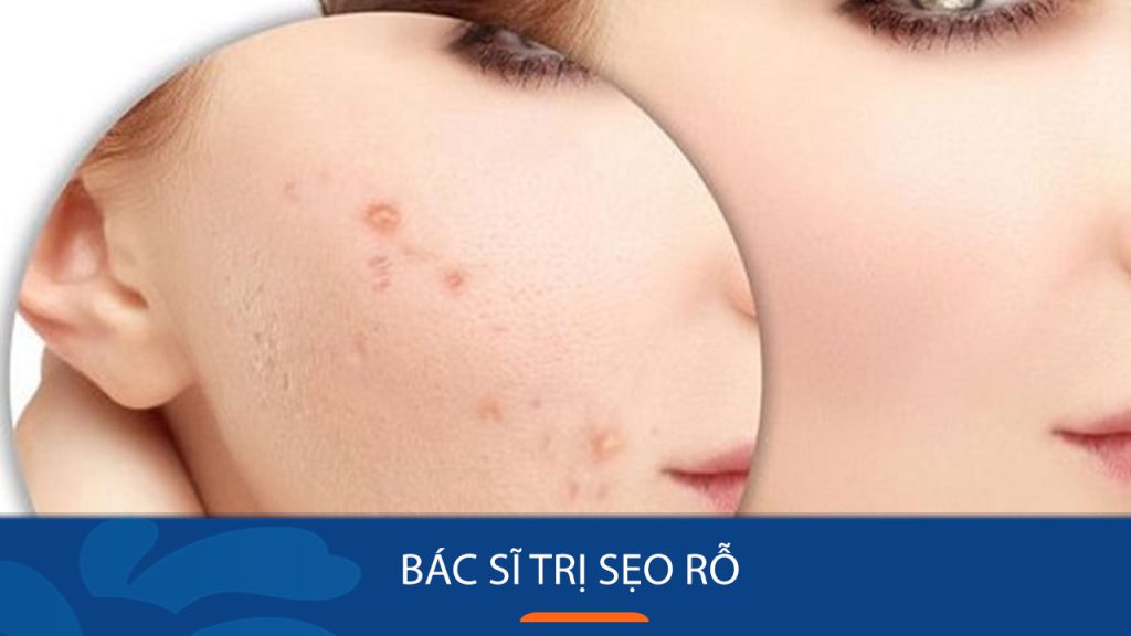 Bác sĩ Da Liễu Chuyên Trị Sẹo Rỗ Uy Tín Tại