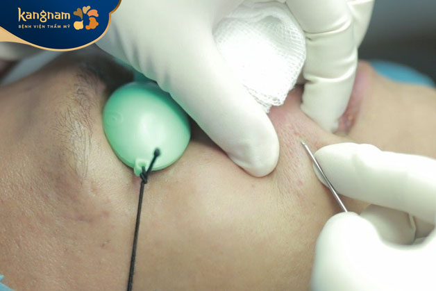 Bóc tách đáy sẹo hiệu quả hơn với đáy sẹo tròn