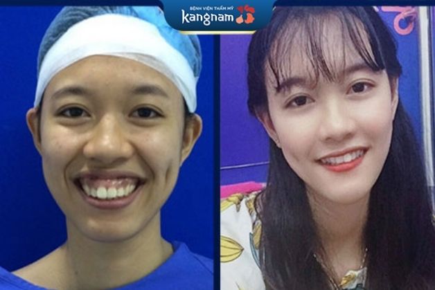 Tỷ lệ răng và lợi cân đối giúp gương mặt trở nên hài hòa, trẻ trung hơn