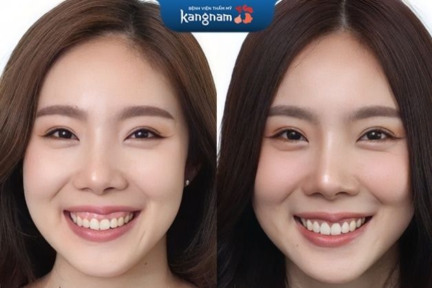 Cắt nướu chữa cười hở lợi