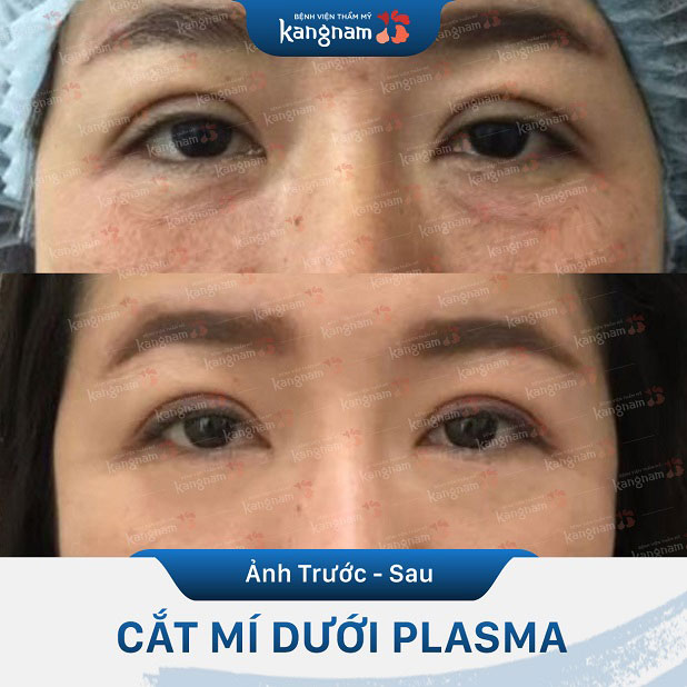 Lựa chọn địa chỉ thẩm mỹ uy tín để lấy mỡ mắt