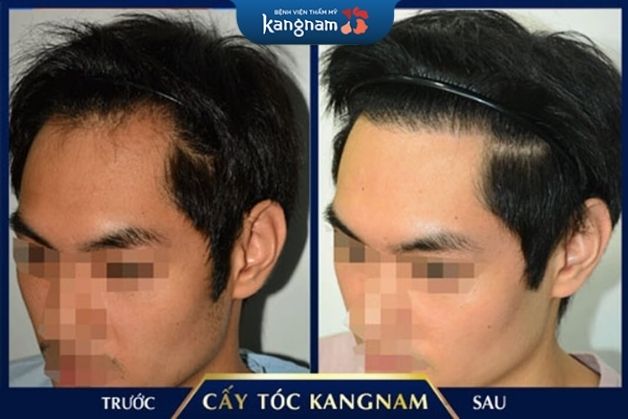 Cấy tóc an toàn, không biến chứng