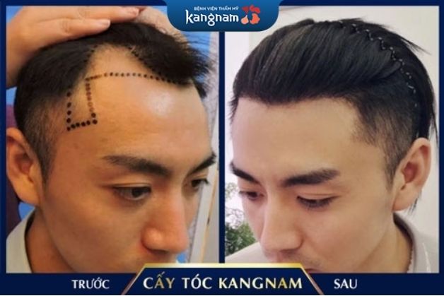 Cải thiện trán bò liếm hiệu quả