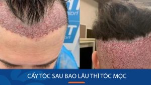 Cấy tóc sau bao lâu thì tóc mọc? Những lưu ý để tóc nhanh mọc lại
