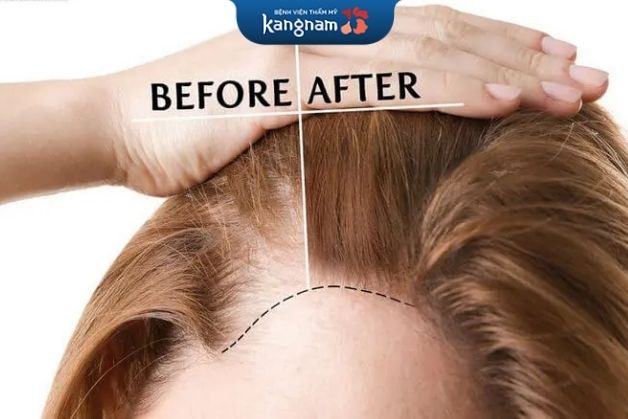 Chăm sóc tóc sau khi cấy cũng là một trong những giai đoạn quan trọng