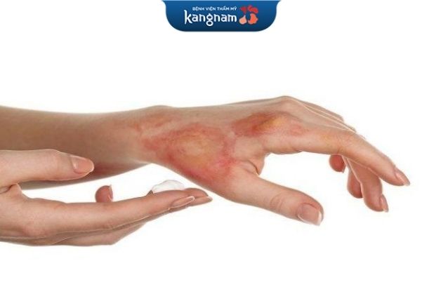 Chăm sóc vết bỏng cẩn thận