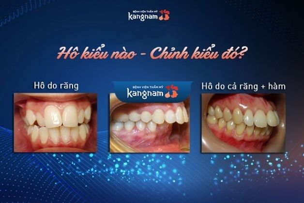 Chỉnh nha lệch khớp cắn an toàn tại Kangnam