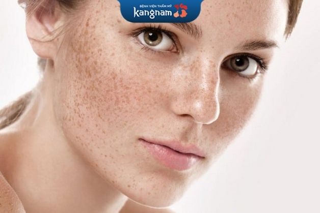 Trị sẹo thâm sau khi bắn laser chữa nám, tàng nhang