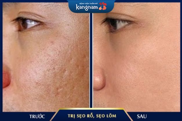 Trị sẹo rỗ dến 90%