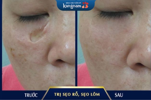 Bác sĩ điều trị sẹo rỗ Kangnam tay nghề cao, cho hiệu quả tối ưu