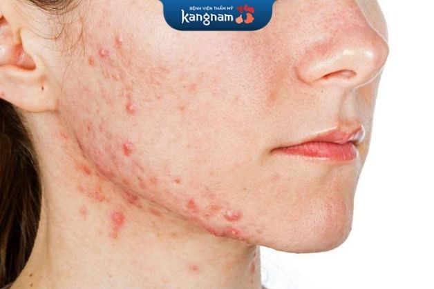 Tránh tiêu thụ thực phẩm dễ gây dị ứng