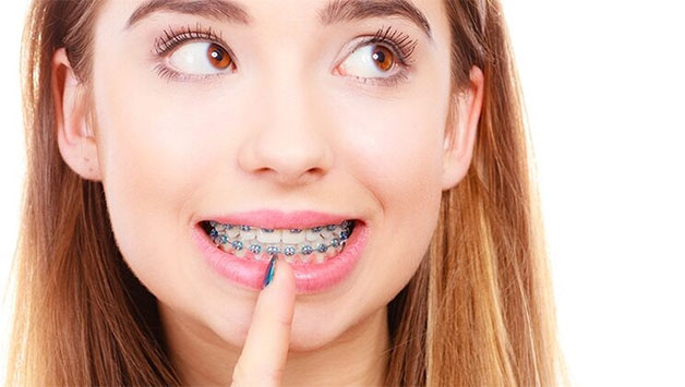 Độn cằm có niềng răng được không?