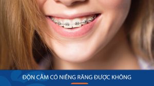 Độn cằm có niềng răng được không? Thứ tự thực hiện & lưu ý quan trọng