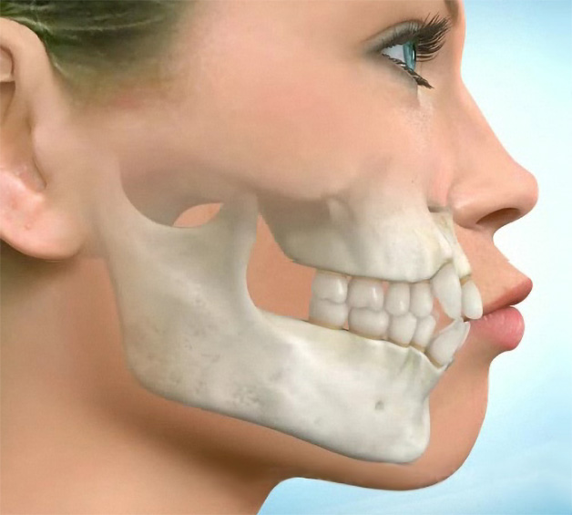 Trường hợp hô hàm không cần niềng răng