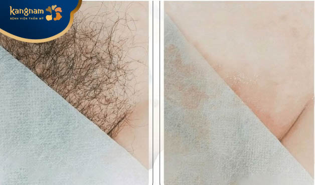 Bạn Trịnh Linh hài lòng sau triệt lông bikini