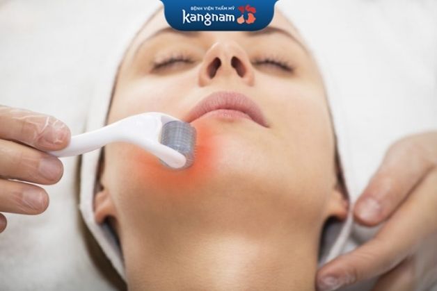 Trị sẹo rỗ bằng laser