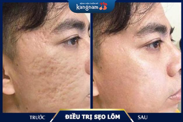 Lý do bạn nên điều trị sẹo rỗ tại Kangnam