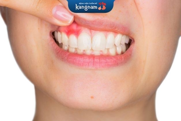 Cắt lợi có thể gây nhiễm trùng nếu không vệ sinh đúng cách