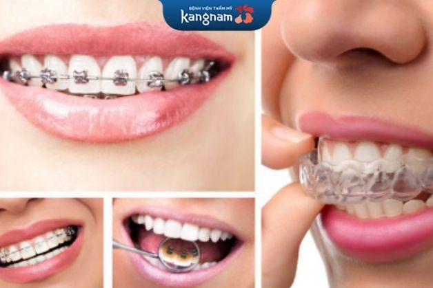 Niềng răng giúp hàm đều hơn