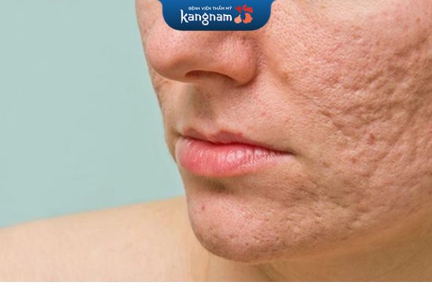 Phan biệt sẹo rỗ và sẹo mụn