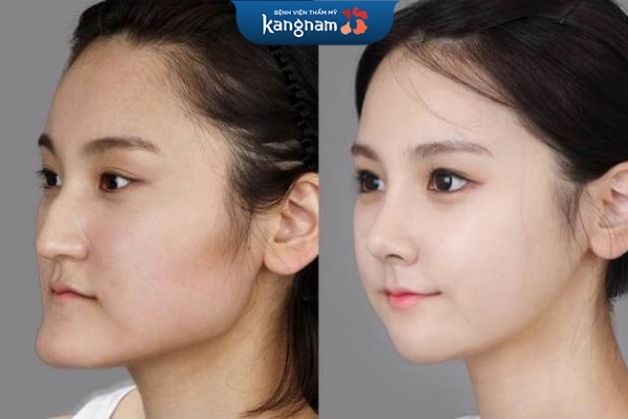 Phẫu thuật chỉnh xương hàm lệch