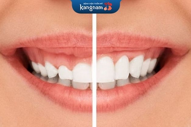 Phẫu thuật cười hở lợi có nguy hiểm không