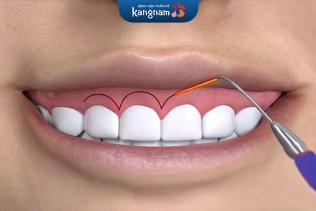 Phẫu thuật cười hở lợi có nguy hiểm không