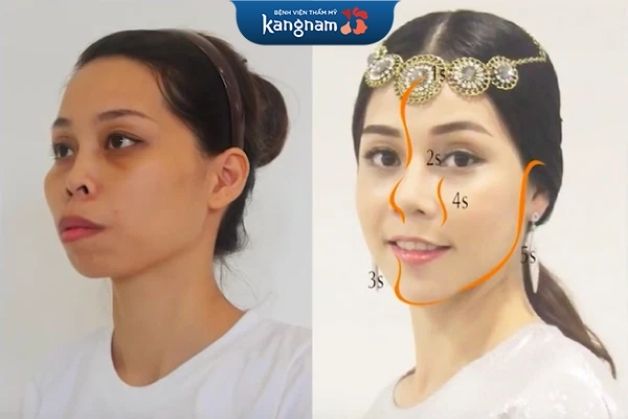 Phẫu thuật hàm hô không cần niềng răng vẫn đảm bảo hiệu quả cao.