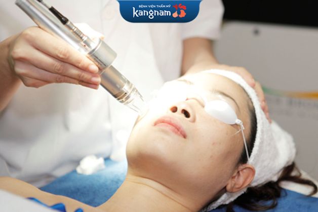 Điều trị sẹo mụn, sẹo lõm bằng tia laser
