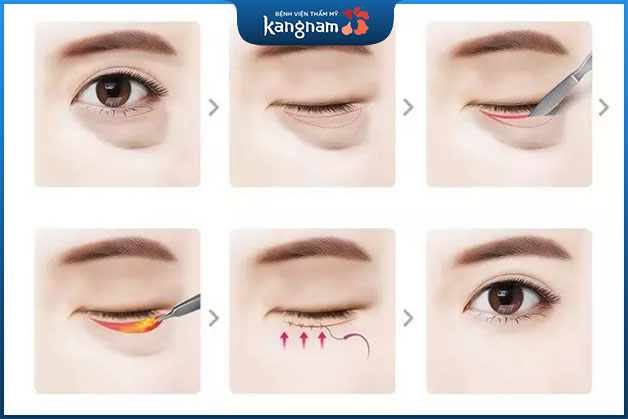 Quy trình lấy mỡ bọng mắt dưới có nguy hiểm không?