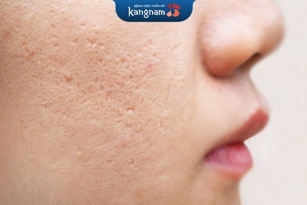 Sẹo đáy  nhọn có hình dạng giống như bị vật nhọn đâm mạnh vào sâu trong da