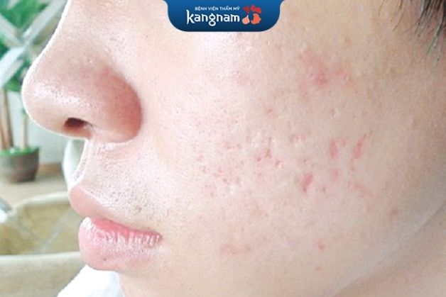 Sẹo đáy tròn giống như những vết lõm trên da, rộng khoảng vài mm